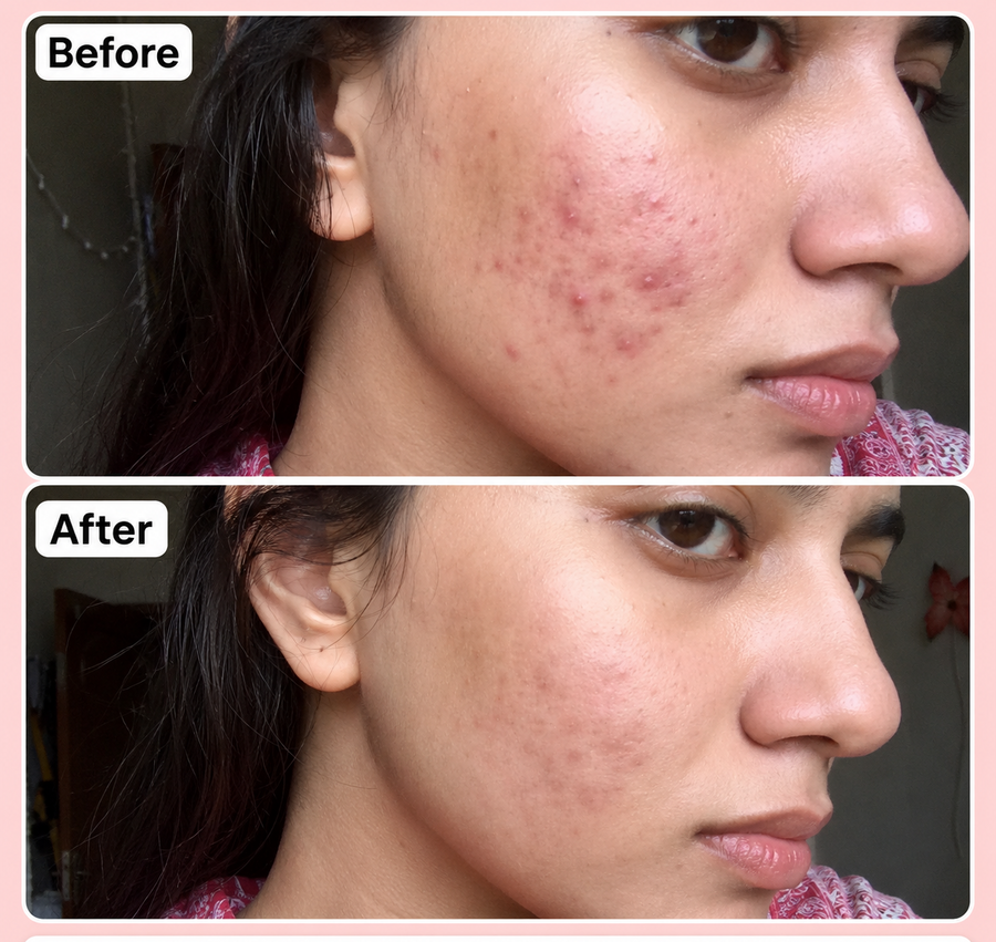 PURGE Acne Care Serum | 2% Salicylic Acid results