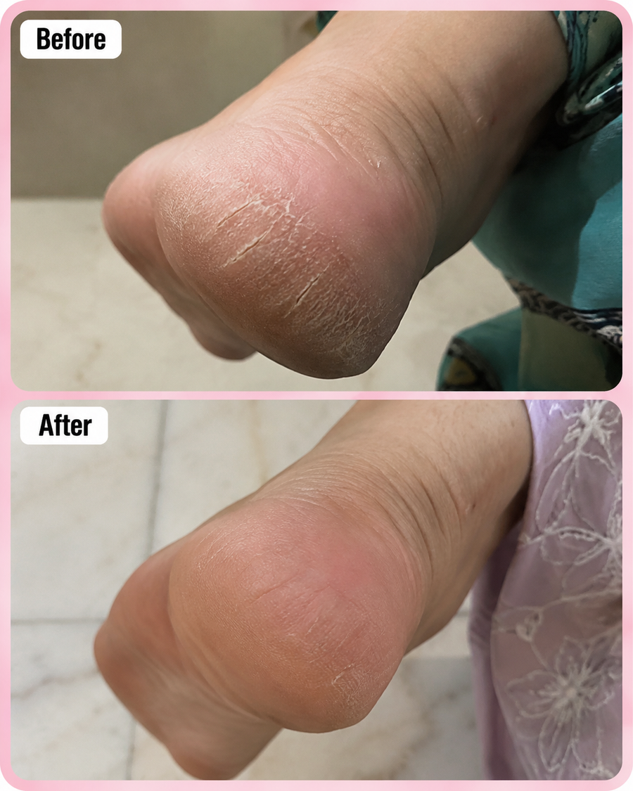 HEELS and SCENTS Cream - Cracked Heel & Foot Odor Remover Cream results