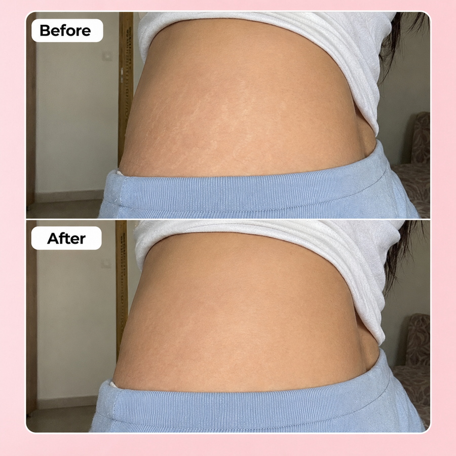 REVIVE Plus Stretch Mark Cream results