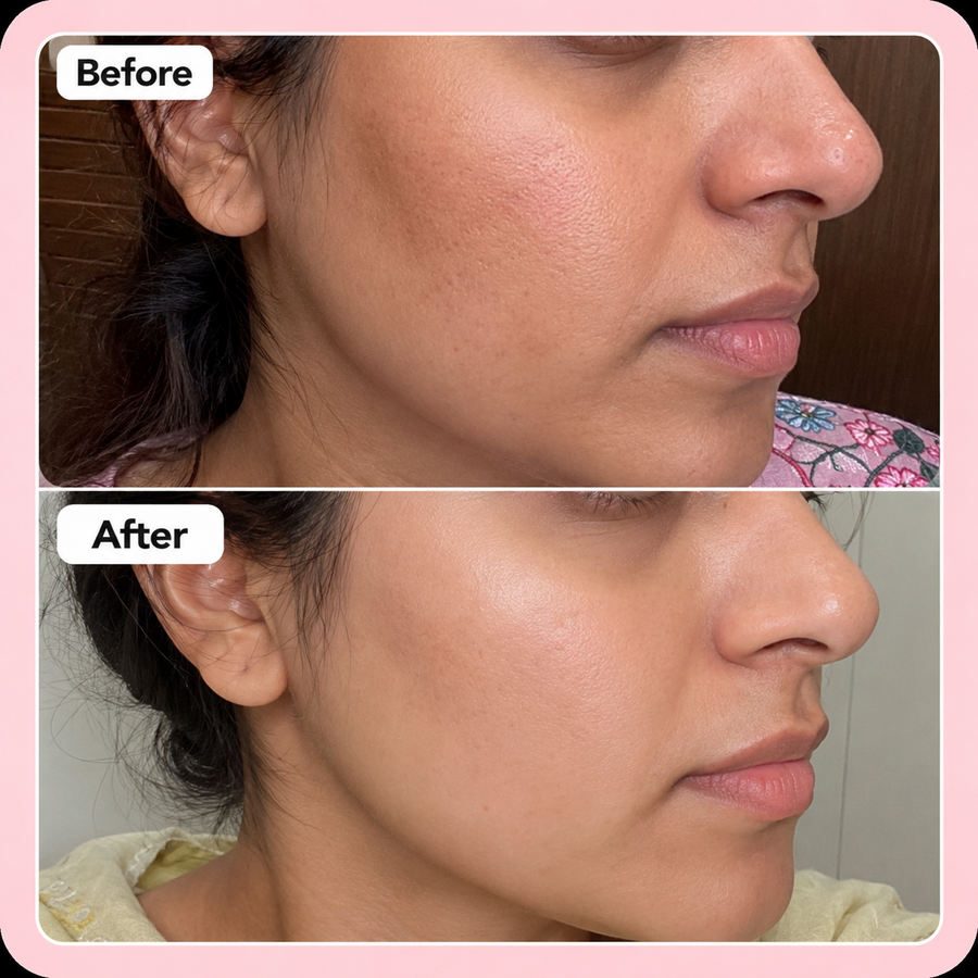 Niacinamide Serum 10% | Pores Minimizer Serum results
