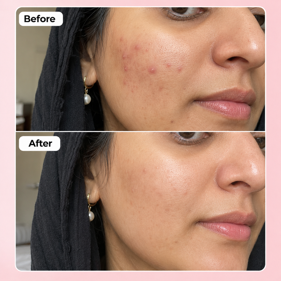 PURGE Acne Care Serum | 2% Salicylic Acid results