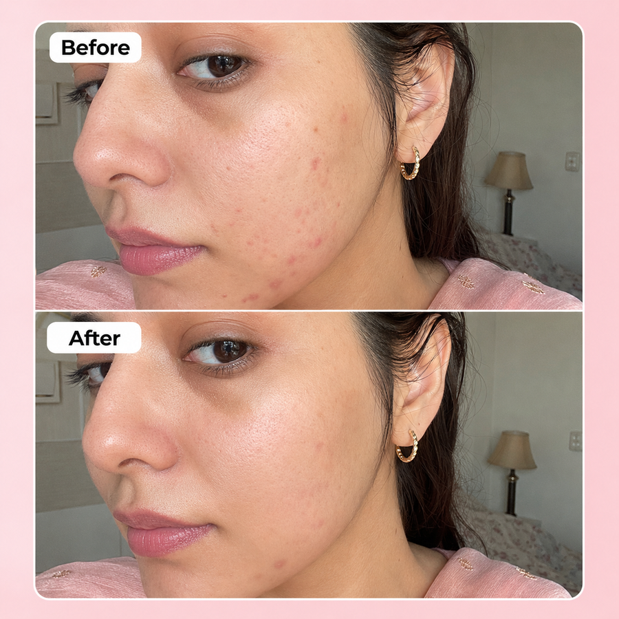 PURGE Acne Care Serum | 2% Salicylic Acid results