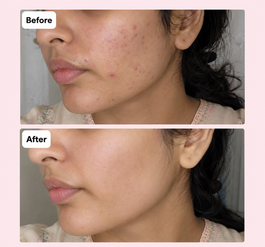 PURGE Acne Care Serum | 2% Salicylic Acid results
