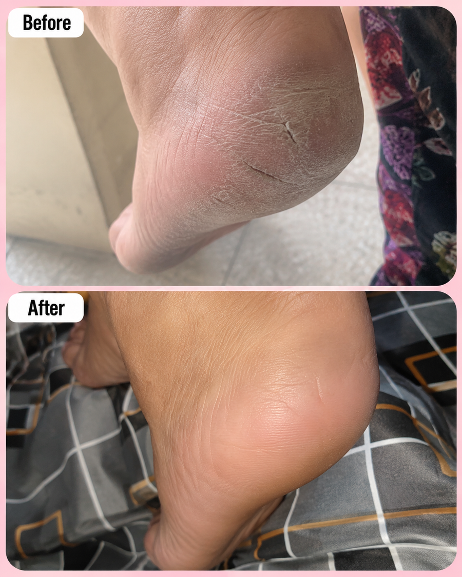 HEELS and SCENTS Cream - Cracked Heel & Foot Odor Remover Cream results