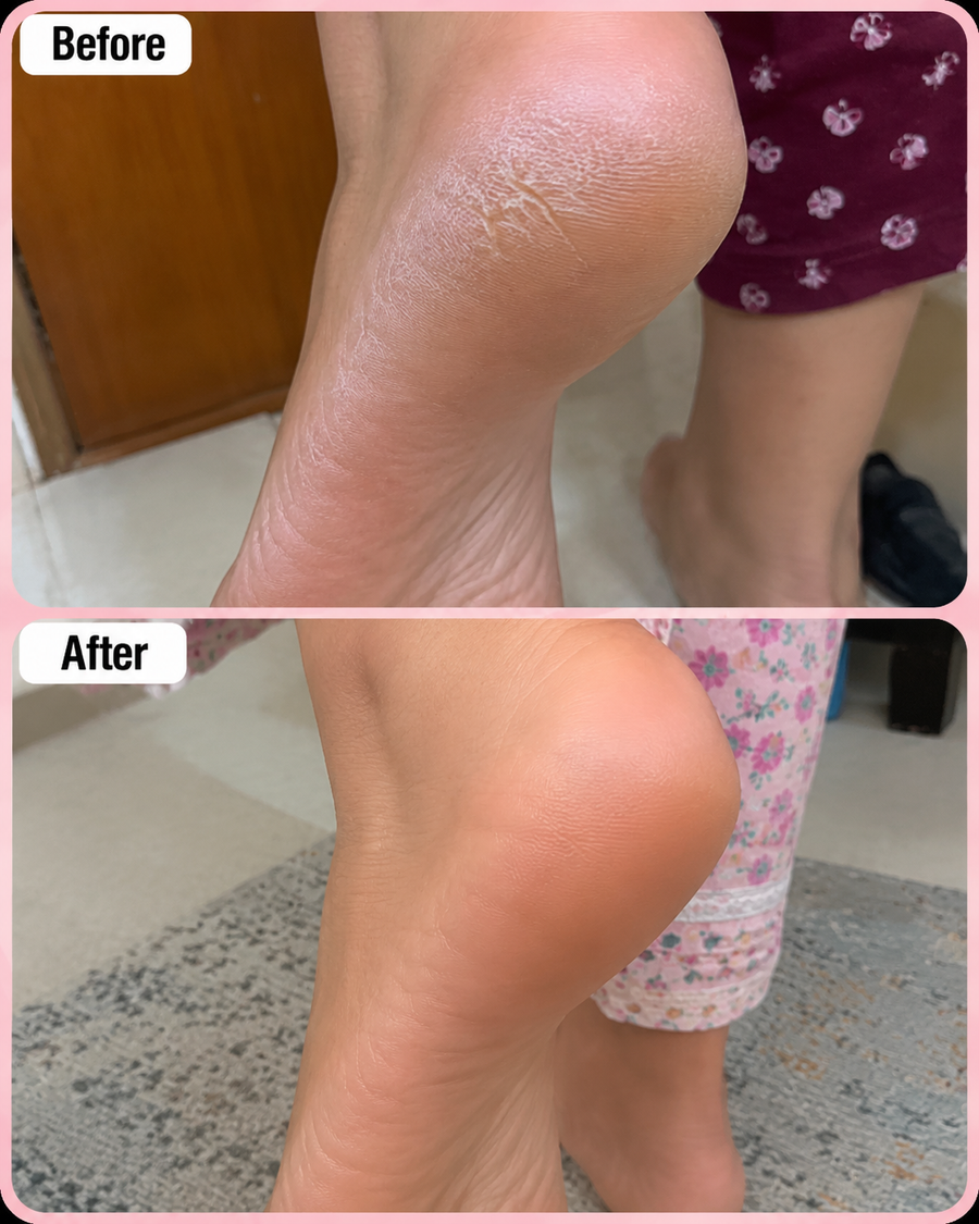HEELS and SCENTS Cream - Cracked Heel & Foot Odor Remover Cream results