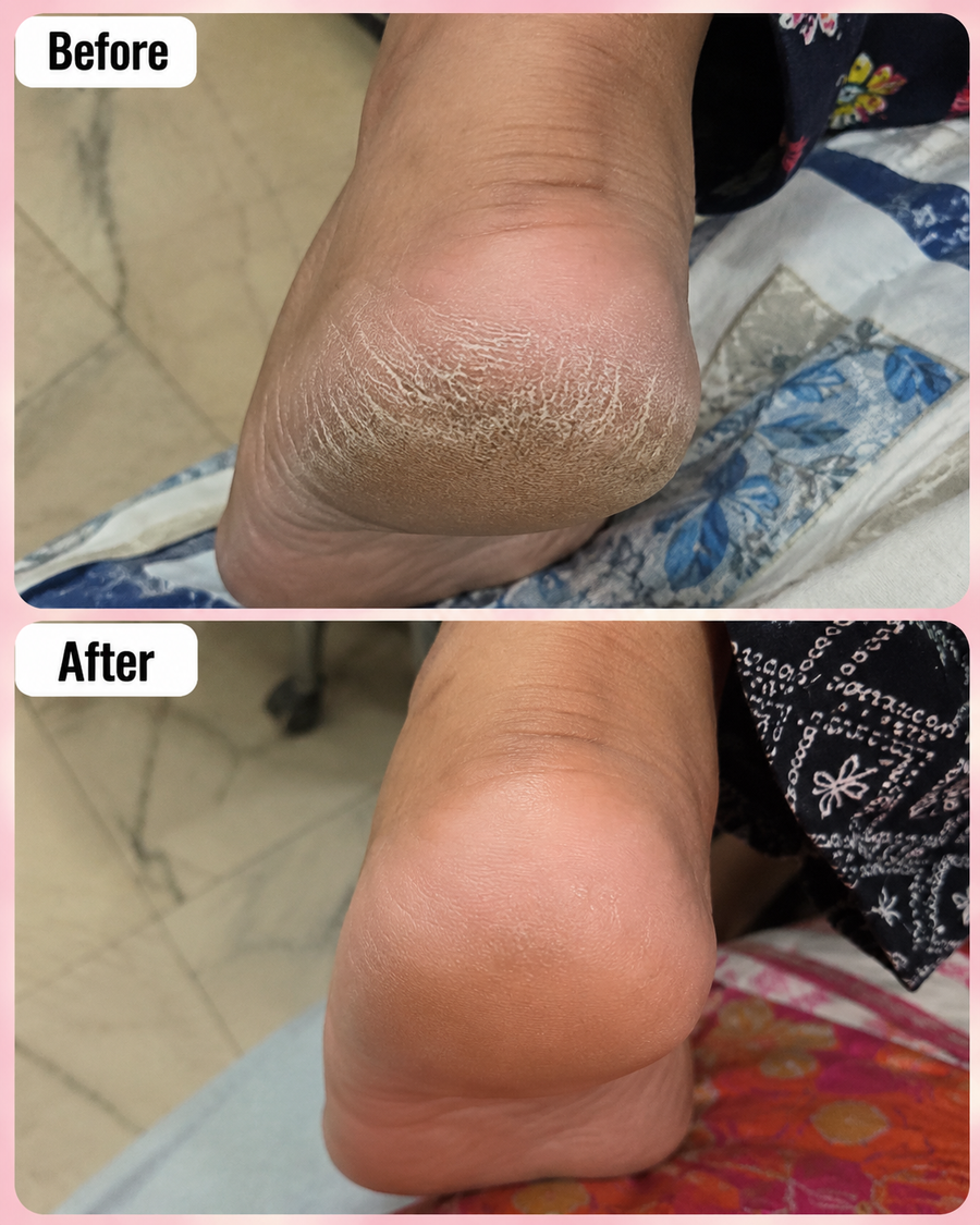HEELS and SCENTS Cream - Cracked Heel & Foot Odor Remover Cream results