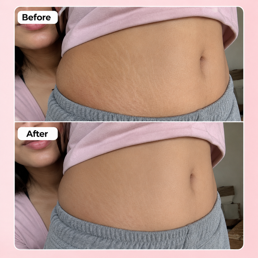 REVIVE Plus Stretch Mark Cream results