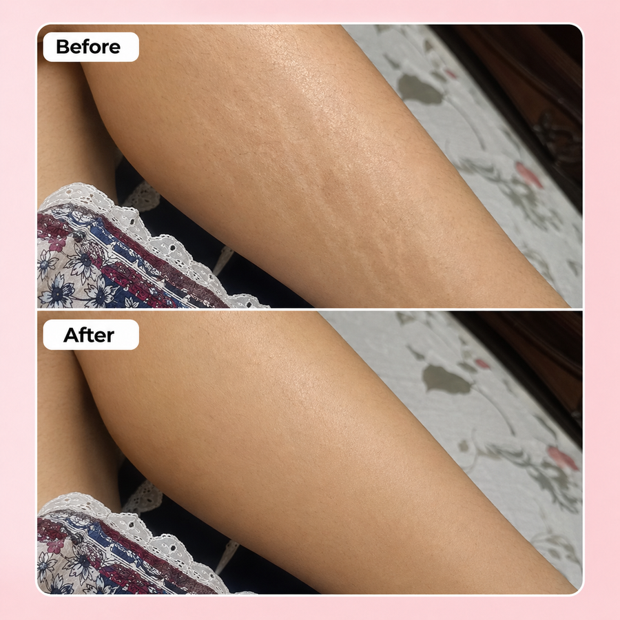 REVIVE Plus Stretch Mark Cream results