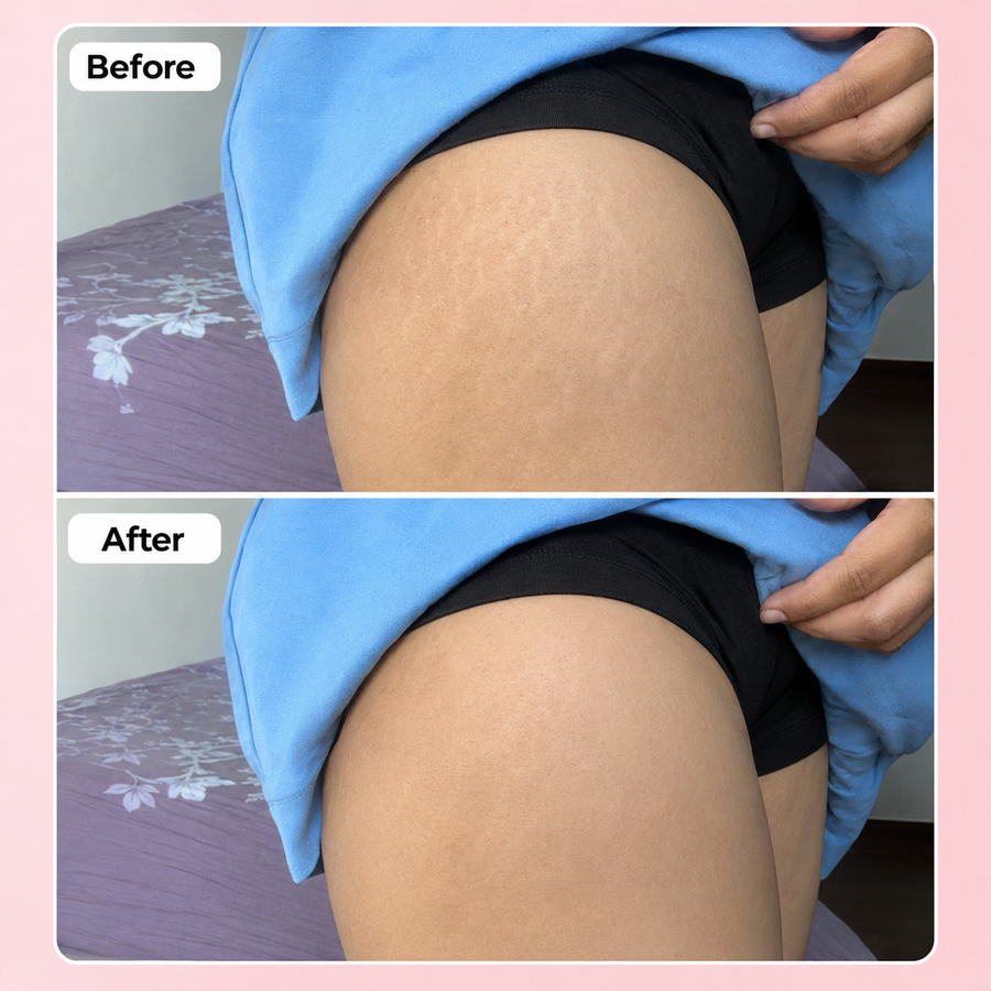 REVIVE Plus Stretch Mark Cream results