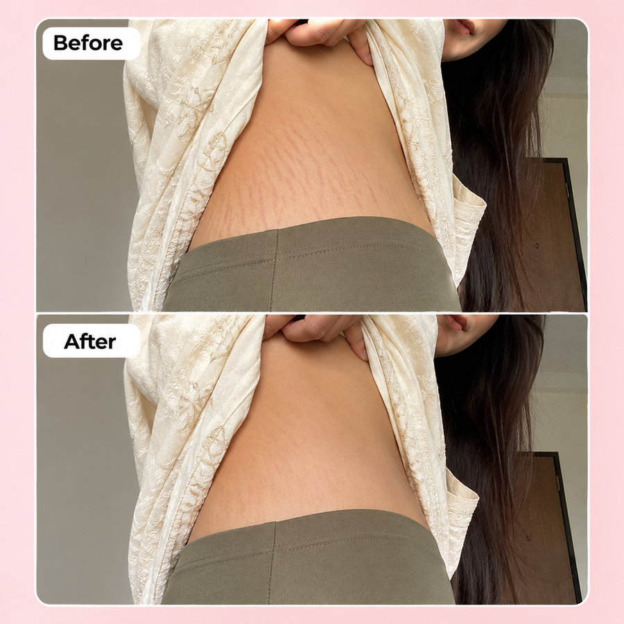 REVIVE Plus Stretch Mark Cream results