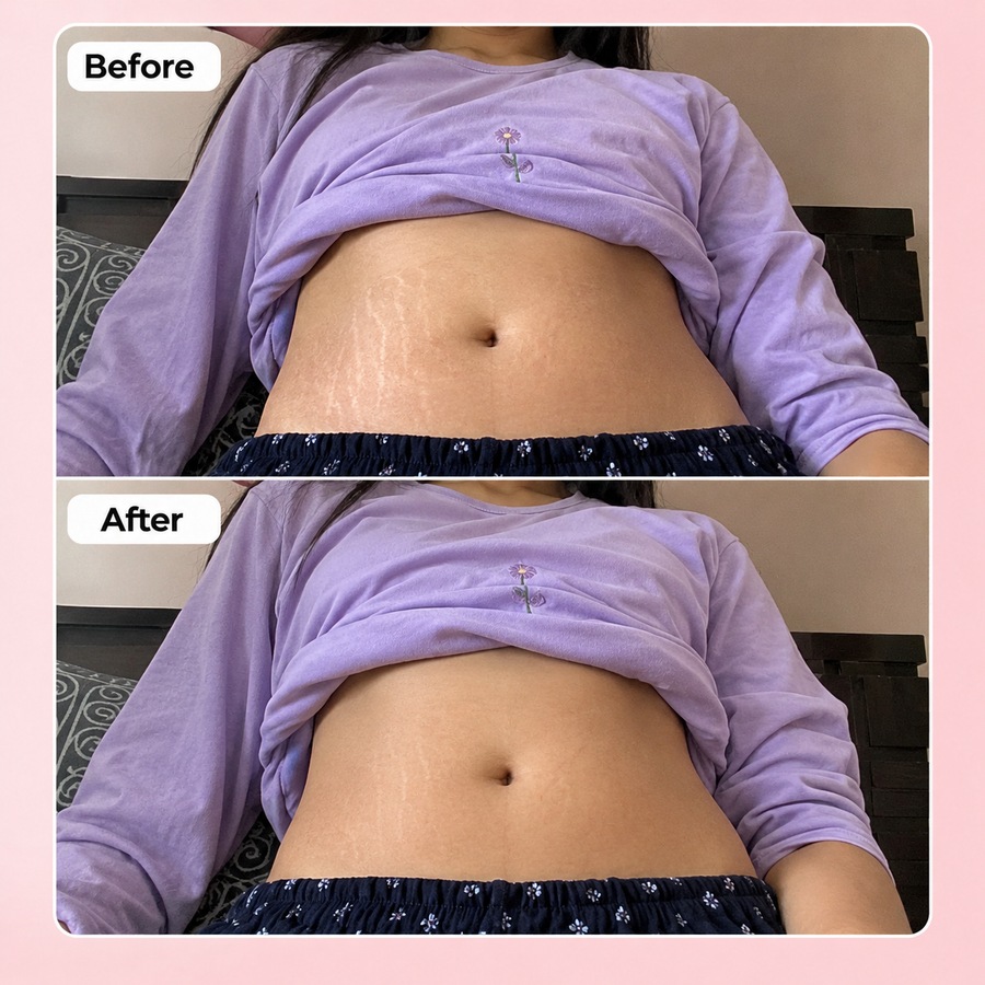 REVIVE Plus Stretch Mark Cream results