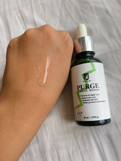 Customer review photo for PURGE Acne Care Serum